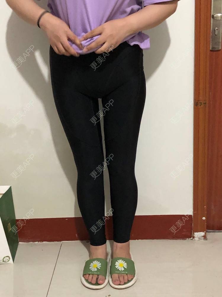 更美 - 更美用户JjeRai1vC1的吸脂瘦大腿经验 | 吸脂瘦大腿 | 吸脂塑臀 | 青岛