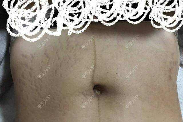 更美 - 更美用户dCshEhQURS的妊娠纹经验 | 上海 | 妊娠纹