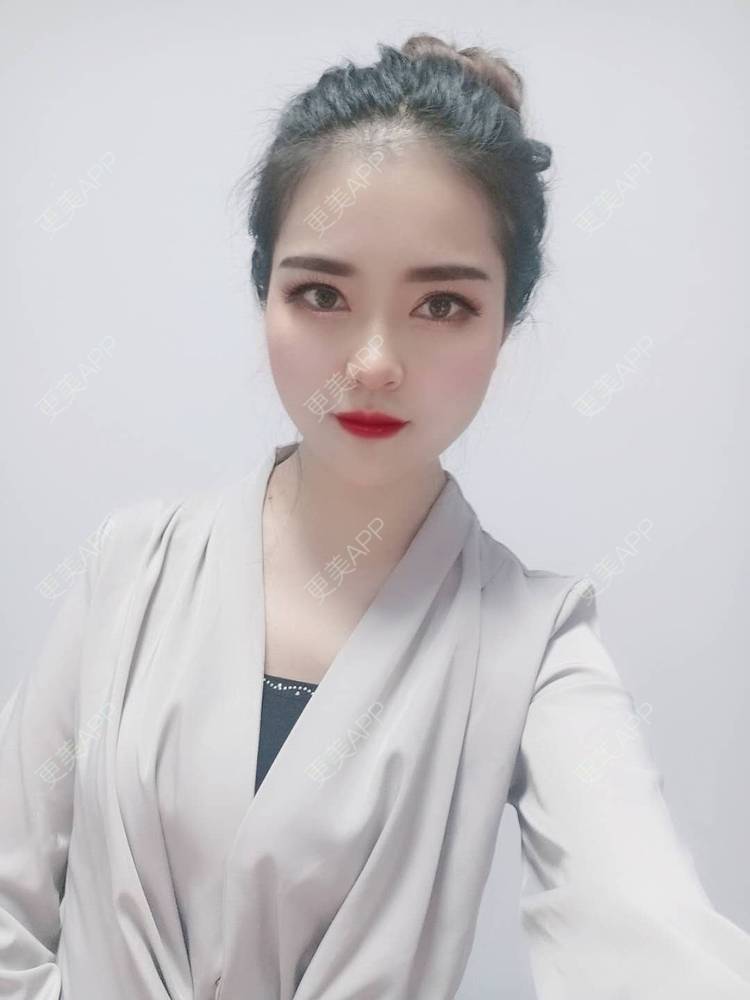 更美 - 更美用户uK1ce6rfue的全切双眼皮经验 | 广州 | 全切双眼皮