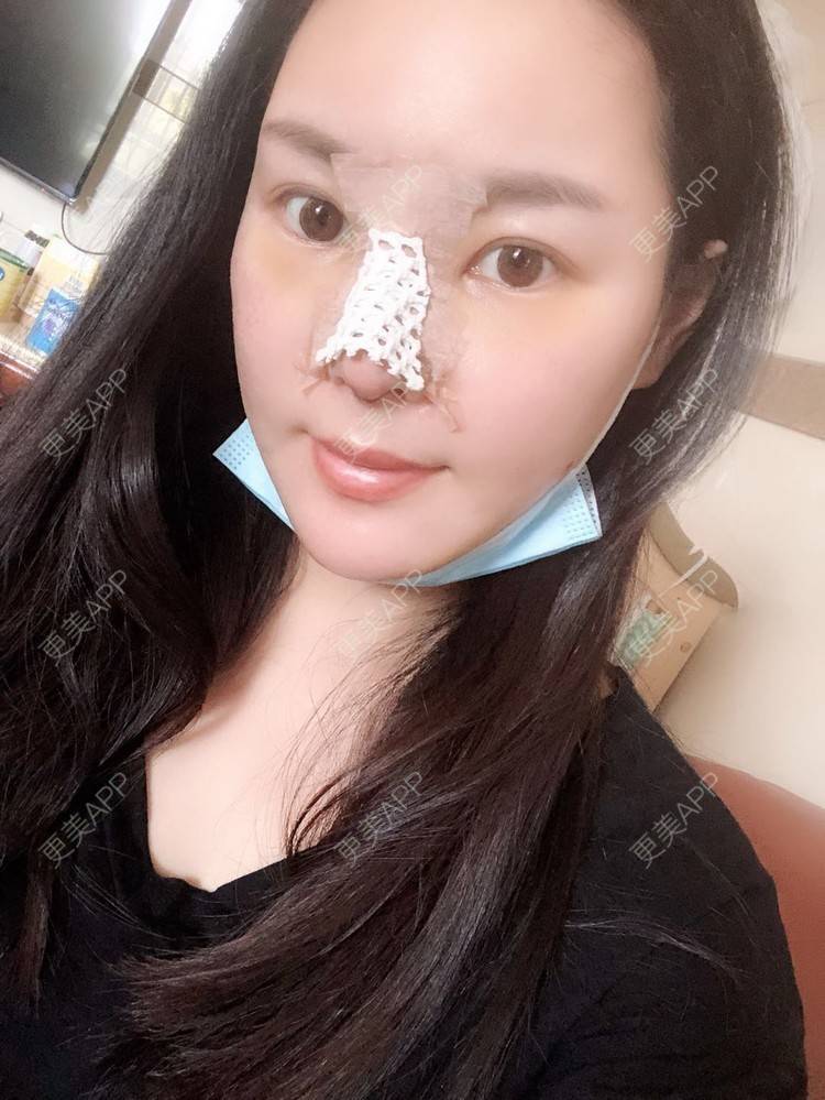 更美 - 更美用户5IGhjClzwr的耳软骨隆鼻经验 | 耳软骨隆鼻 | 隆鼻 | 鼻头整形