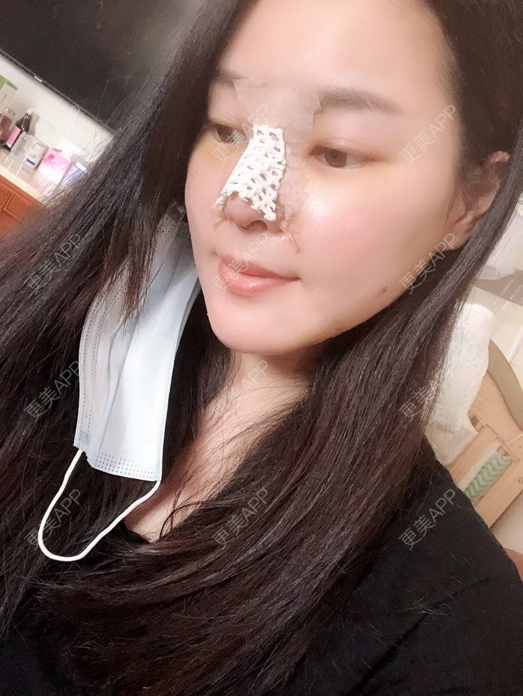更美 - 更美用户5IGhjClzwr的耳软骨隆鼻经验 | 耳软骨隆鼻 | 隆鼻 | 鼻头整形