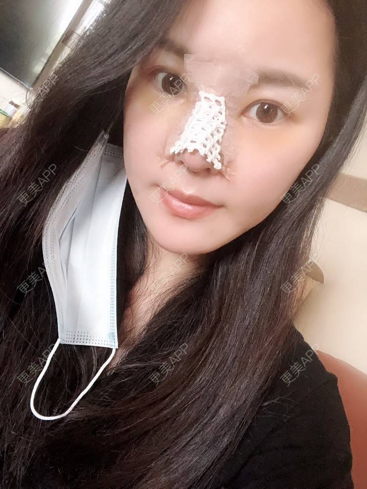 更美 - 更美用户5IGhjClzwr的耳软骨隆鼻经验 | 耳软骨隆鼻 | 隆鼻 | 鼻头整形