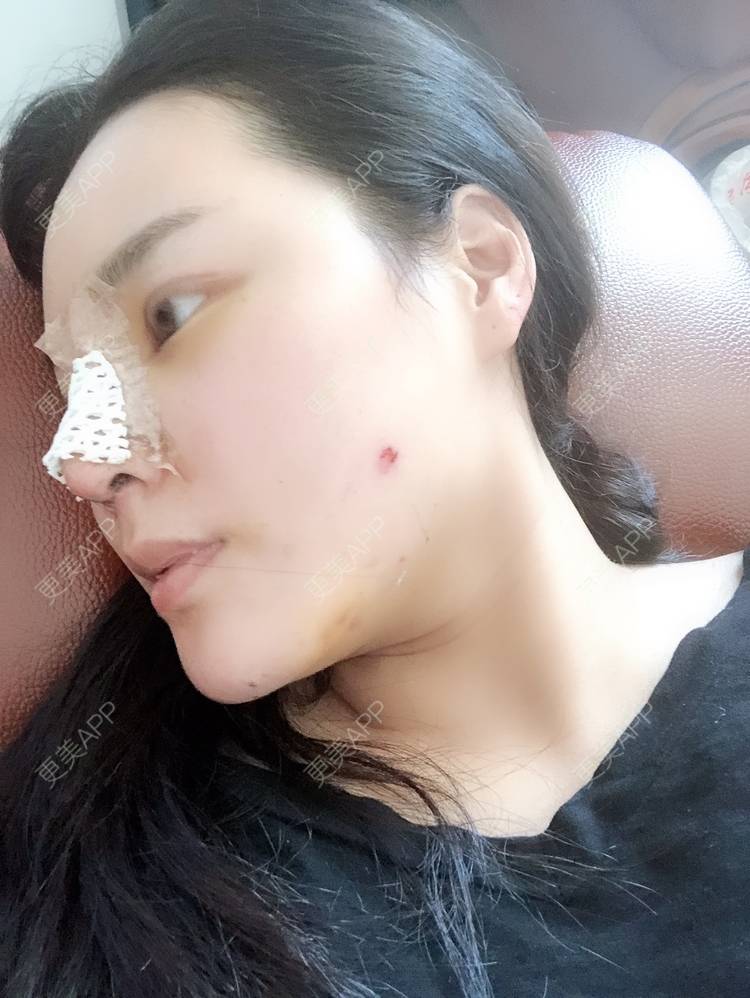 更美 - 更美用户5IGhjClzwr的耳软骨隆鼻经验 | 耳软骨隆鼻 | 隆鼻 | 鼻头整形