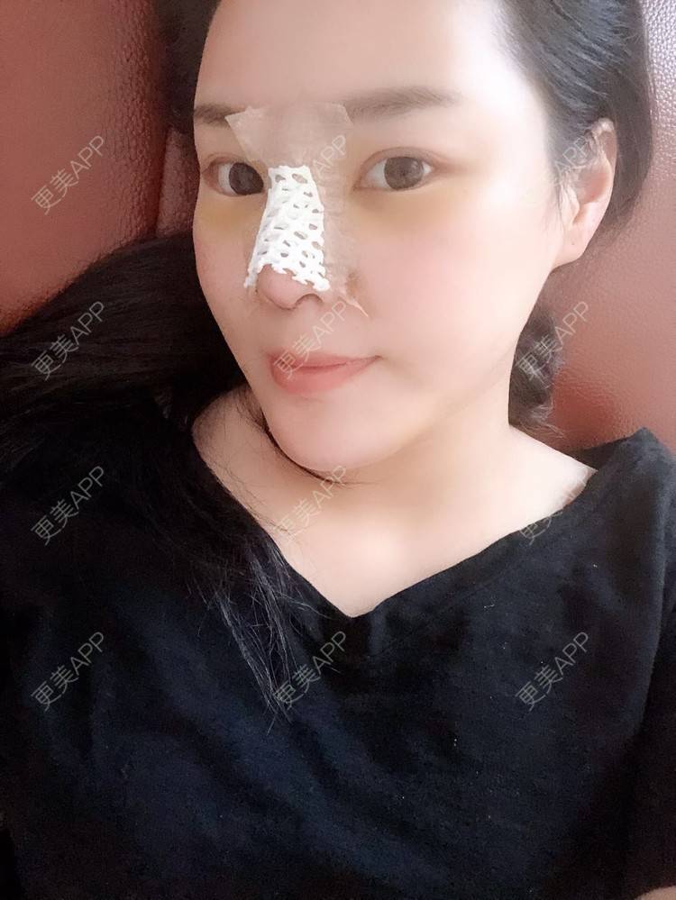 更美 - 更美用户5IGhjClzwr的耳软骨隆鼻经验 | 耳软骨隆鼻 | 隆鼻 | 鼻头整形