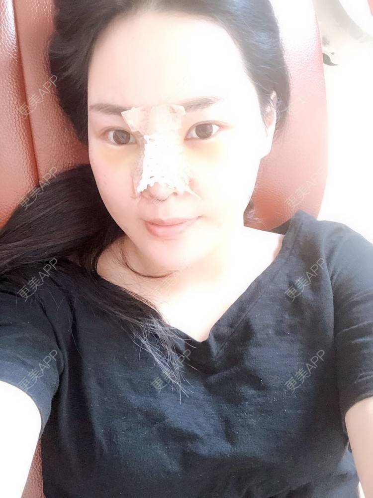 更美 - 更美用户5IGhjClzwr的耳软骨隆鼻经验 | 耳软骨隆鼻 | 隆鼻 | 鼻头整形