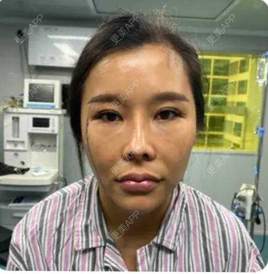 更美 - 更美用户orlDKOxECw的拉皮经验 | 拉皮 | 上海