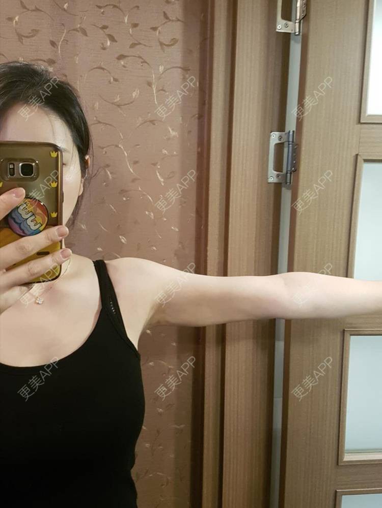 丢猫少年晨的手臂吸脂日记