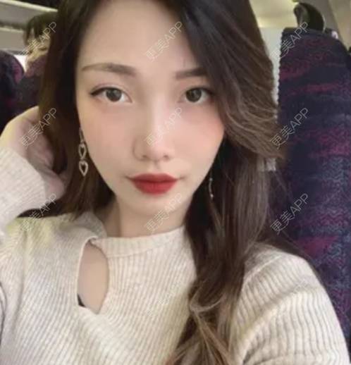 更美 - 更美用户e7UXsfgWyn的拉皮经验 | 拉皮 | 上海