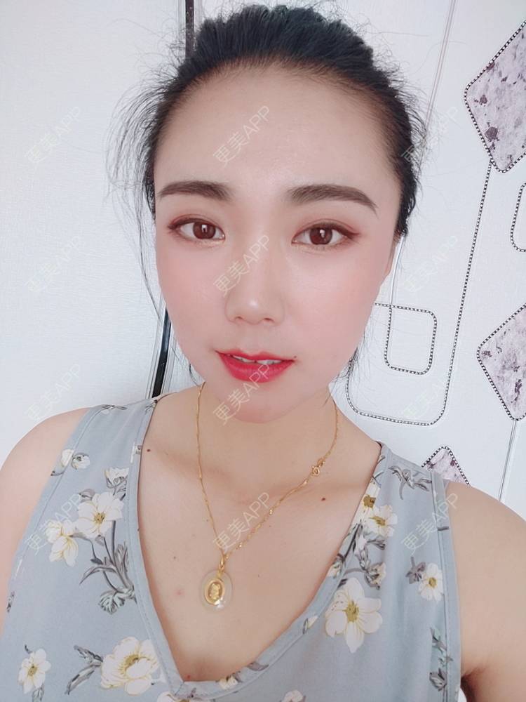 更美 - 更美魔女的埋线提升经验 | 埋线提升 | 郑州