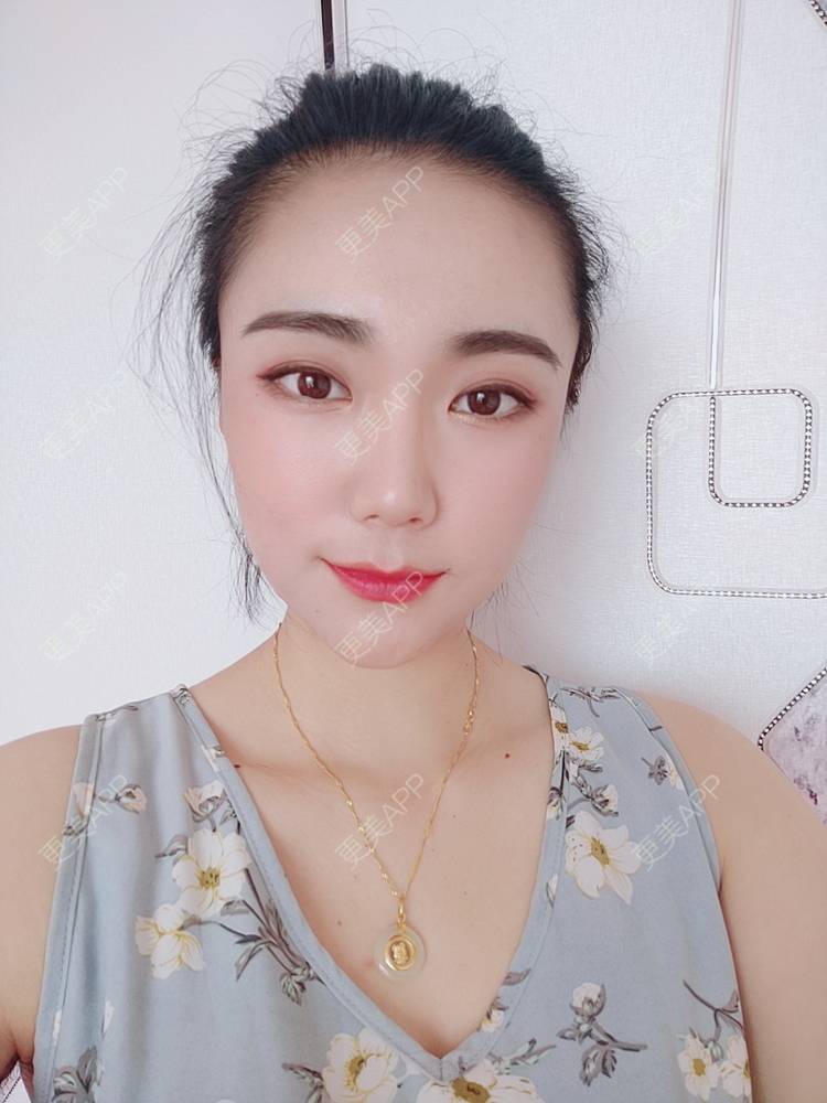 更美 - 更美魔女的埋线提升经验 | 埋线提升 | 郑州