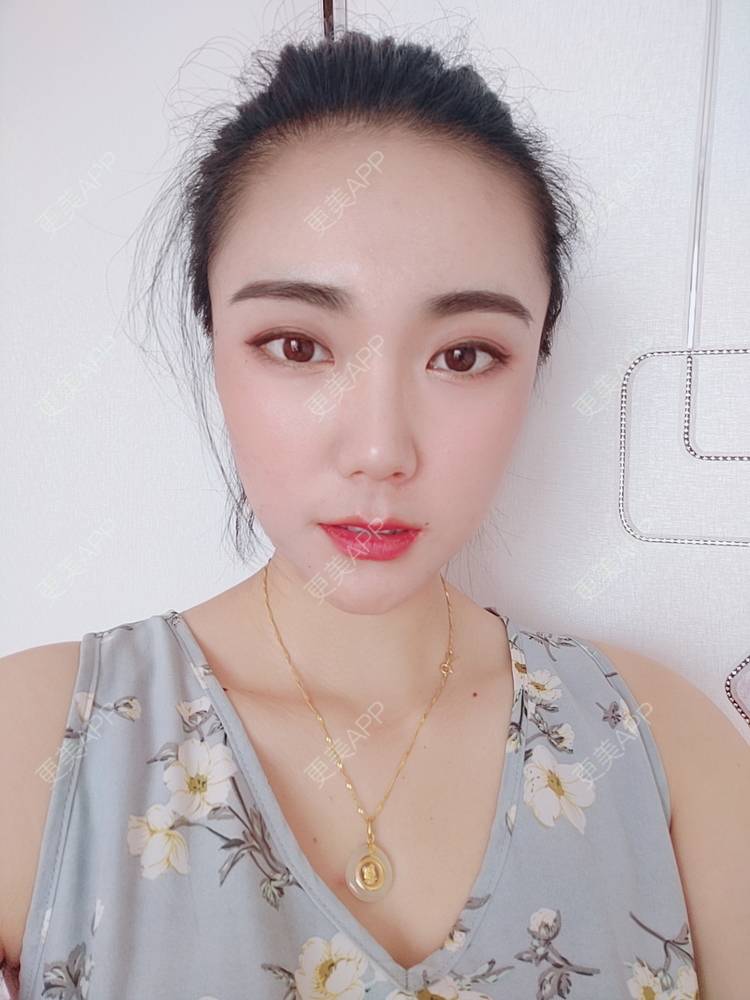 更美 - 更美魔女的埋线提升经验 | 埋线提升 | 郑州