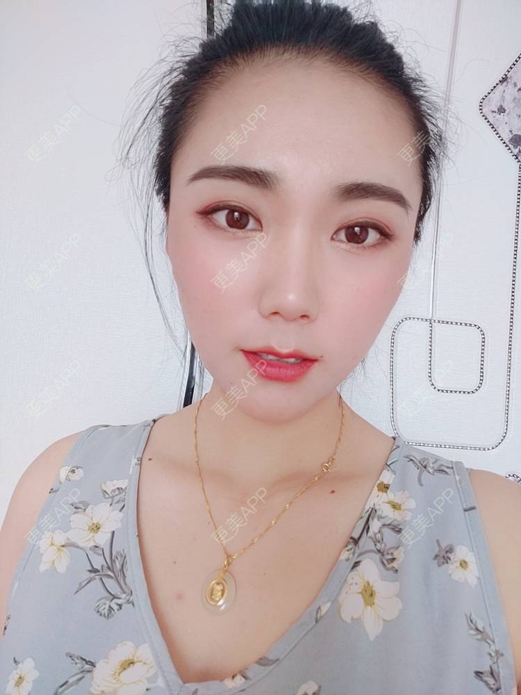 更美 - 更美魔女的埋线提升经验 | 埋线提升 | 郑州