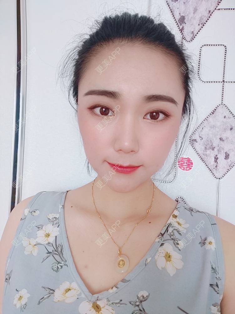 更美 - 更美魔女的埋线提升经验 | 埋线提升 | 郑州