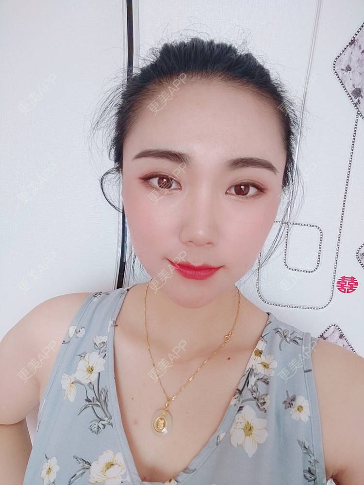 更美 - 更美魔女的埋线提升经验 | 埋线提升 | 郑州