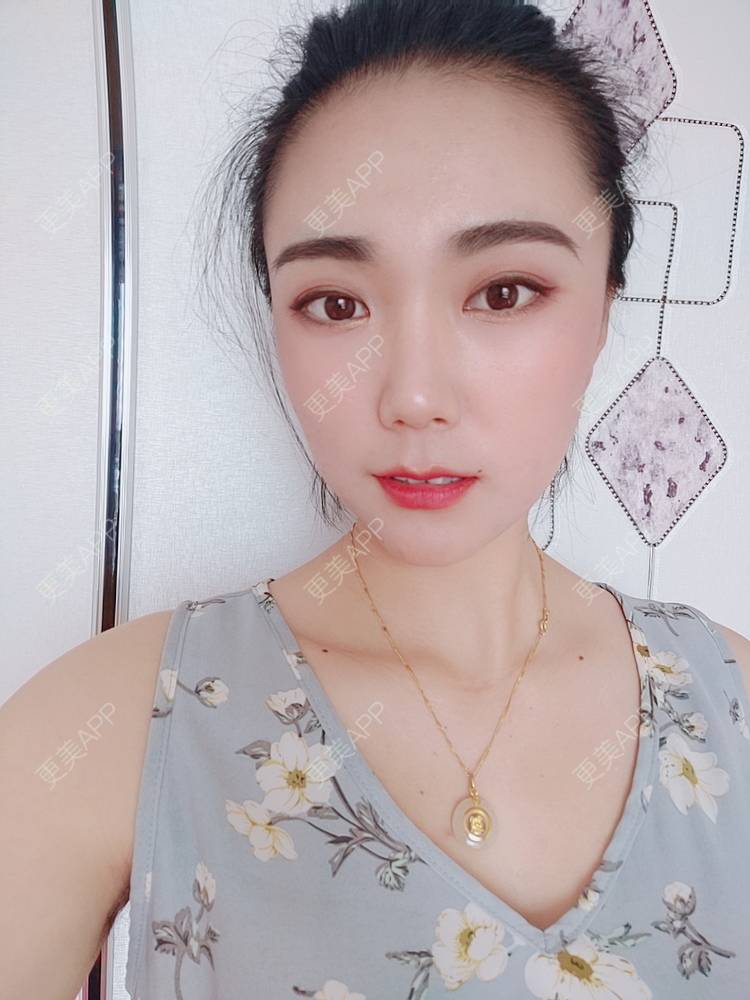 更美 - 更美魔女的埋线提升经验 | 埋线提升 | 郑州