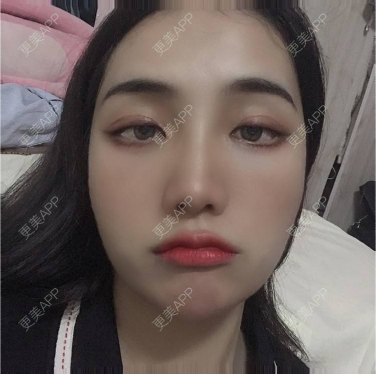 更美 - •你的小可爱•的面部脱毛经验 | 面部脱毛 | 玻尿酸泪沟 | 玻尿酸鼻部 | 玻尿酸下巴 | 深圳