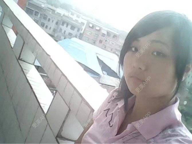 更美 - •你的小可爱•的面部脱毛经验 | 面部脱毛 | 玻尿酸泪沟 | 玻尿酸鼻部 | 玻尿酸下巴 | 深圳