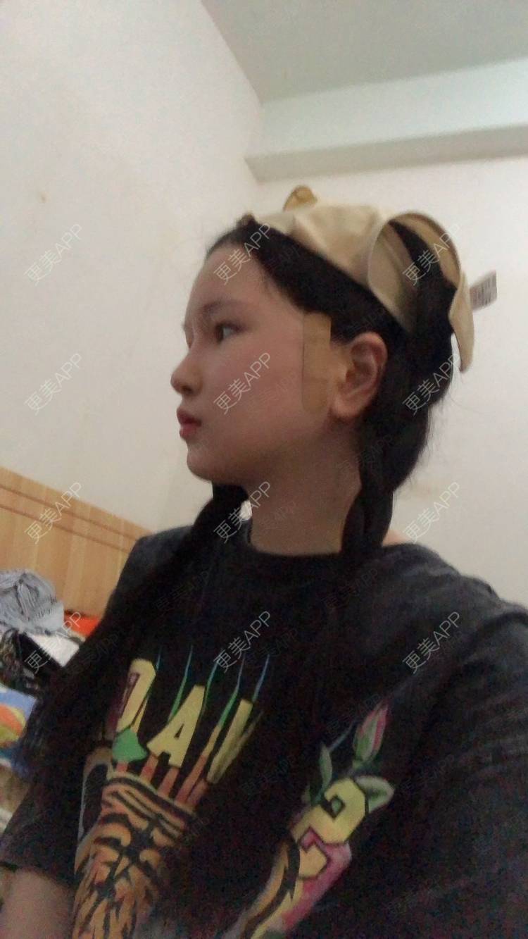 更美 - 更美用户1hOuWDVG0V的下颌角经验 | 成都 | 下颌角
