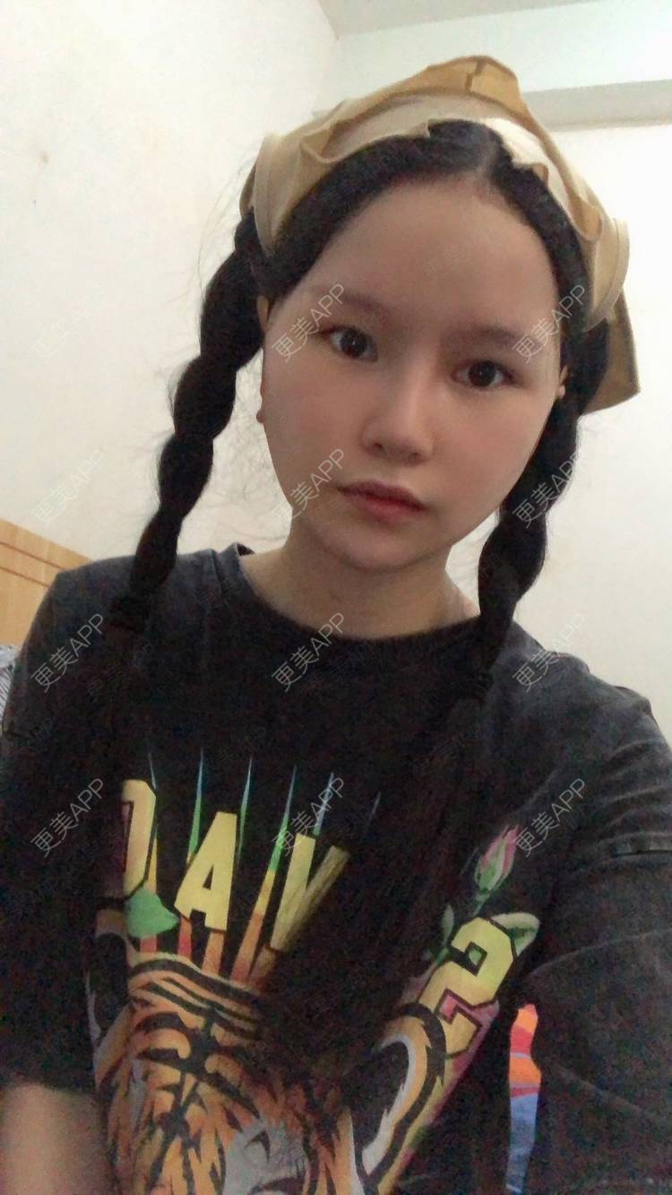 更美 - 更美用户1hOuWDVG0V的下颌角经验 | 成都 | 下颌角
