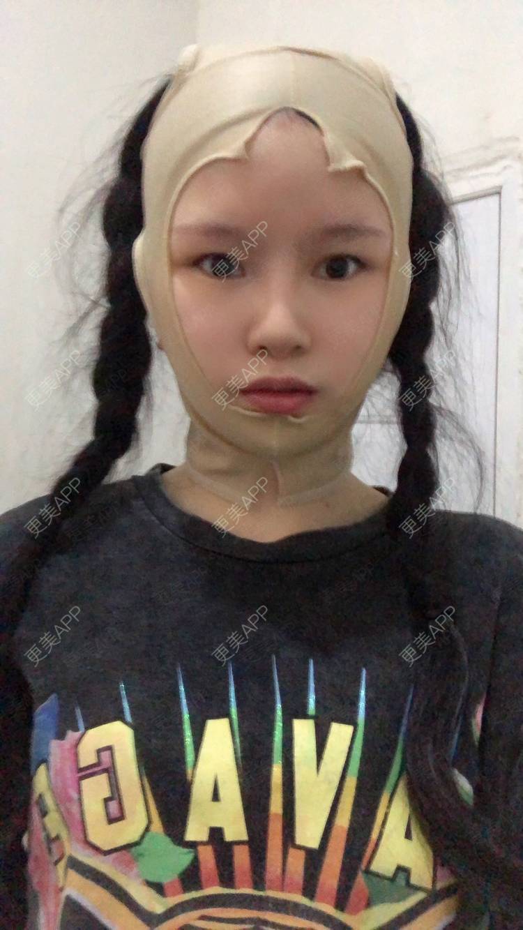 更美 - 更美用户1hOuWDVG0V的下颌角经验 | 成都 | 下颌角