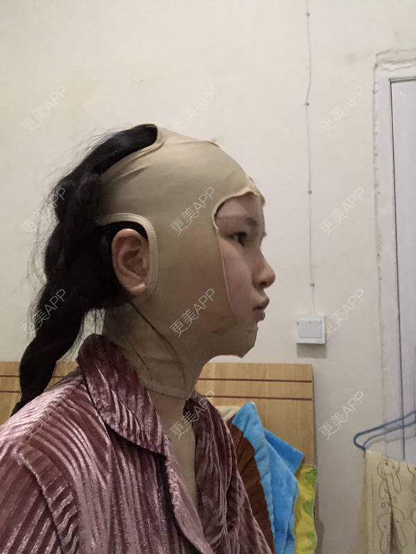更美 - 更美用户1hOuWDVG0V的下颌角经验 | 成都 | 下颌角