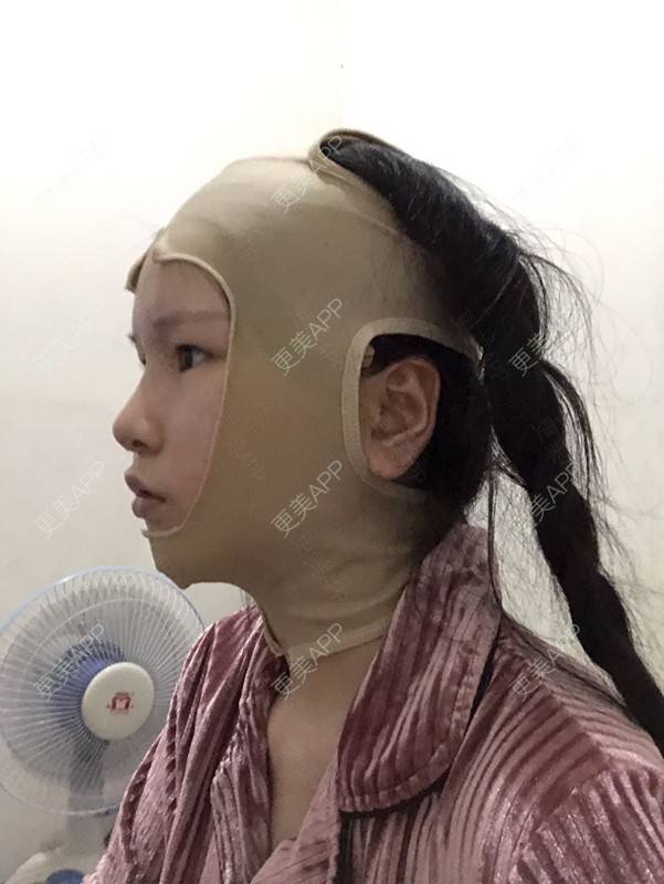 更美 - 更美用户1hOuWDVG0V的下颌角经验 | 成都 | 下颌角