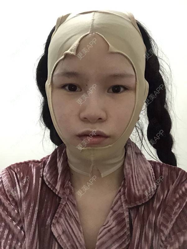 更美 - 更美用户1hOuWDVG0V的下颌角经验 | 成都 | 下颌角