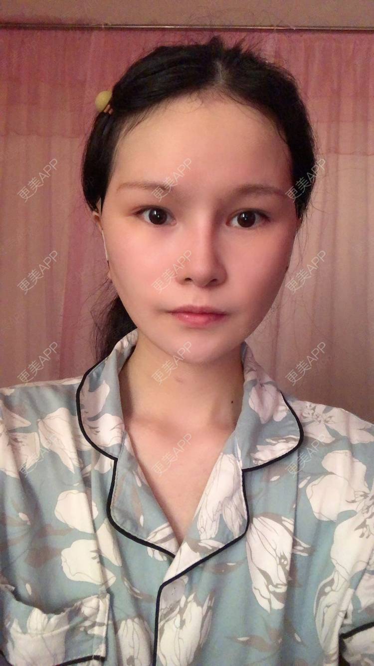 更美 - 更美用户1hOuWDVG0V的下颌角经验 | 成都 | 下颌角