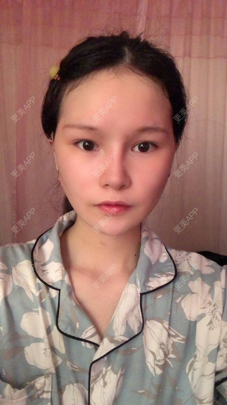 更美 - 更美用户1hOuWDVG0V的下颌角经验 | 成都 | 下颌角