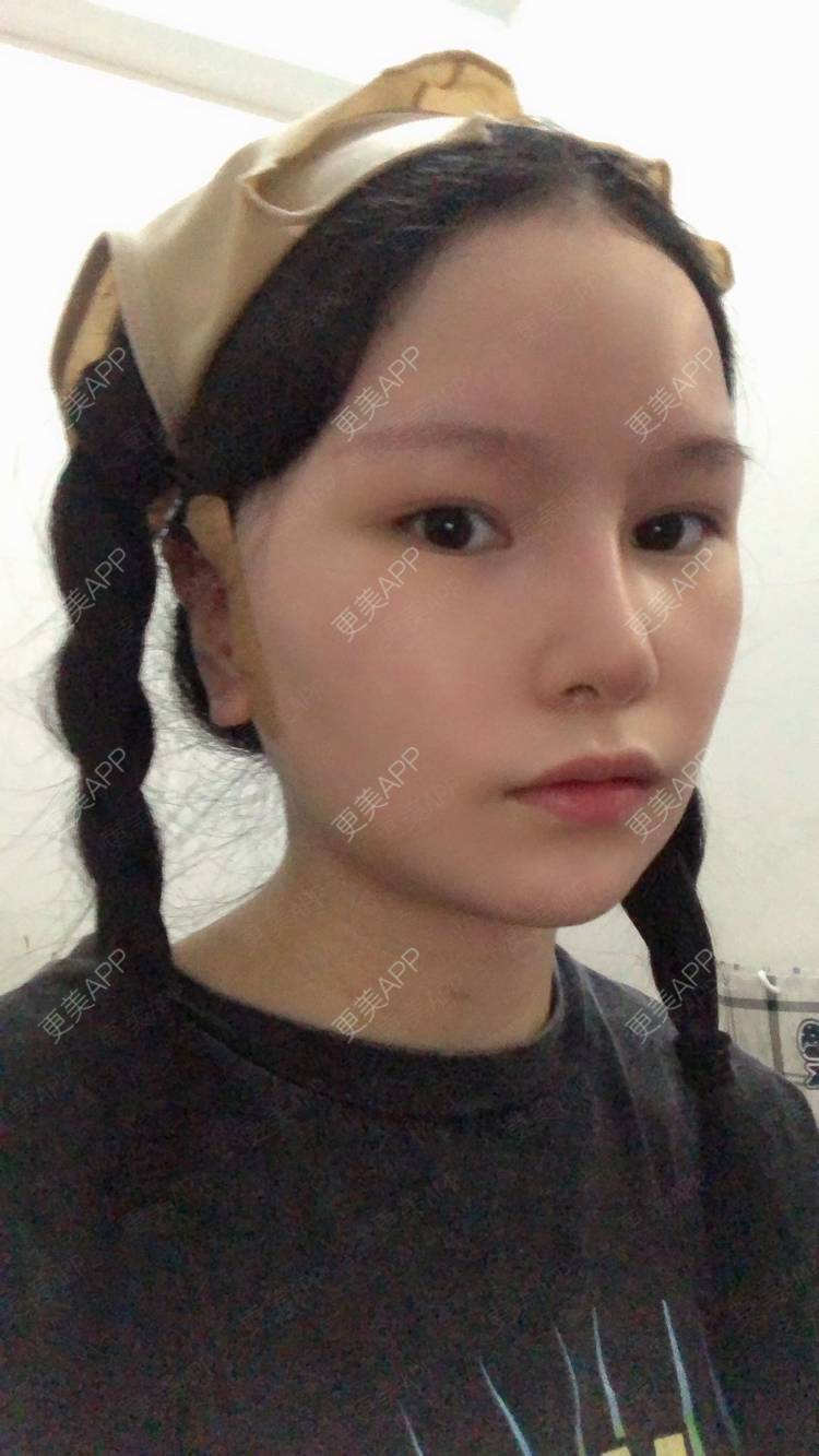 更美 - 更美用户1hOuWDVG0V的下颌角经验 | 成都 | 下颌角