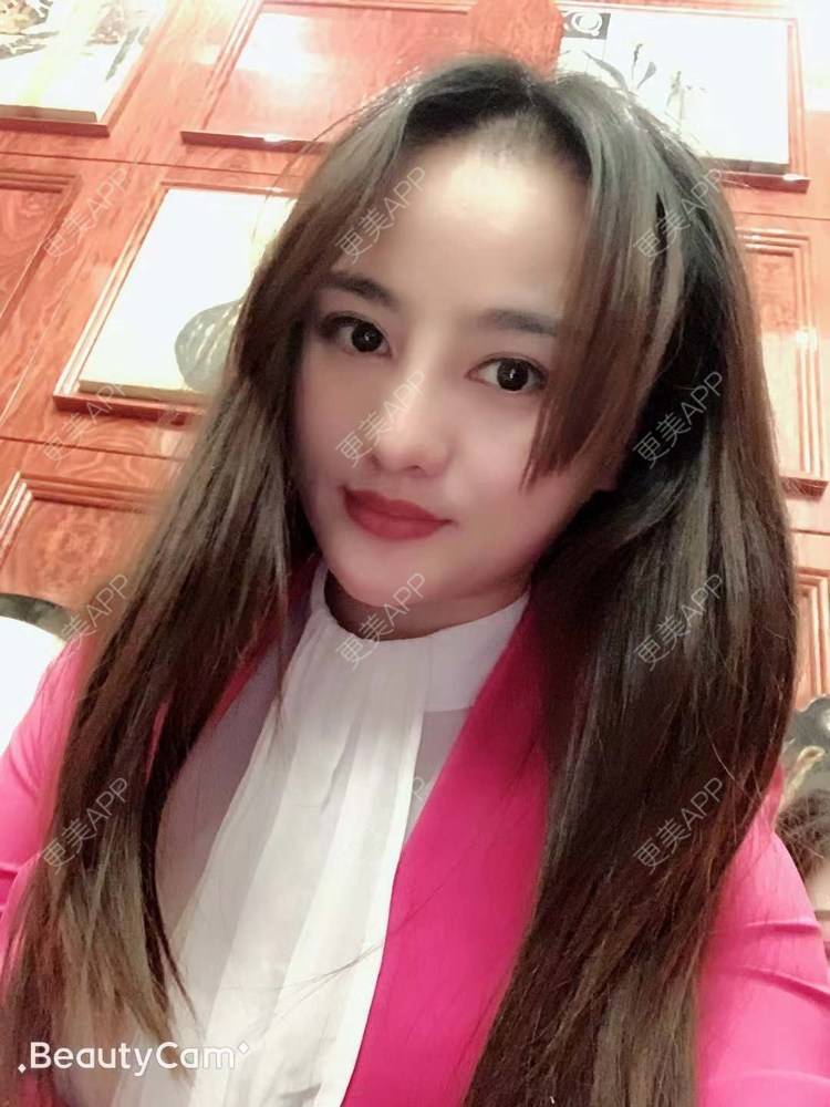 更美 - 更美用户tYzlahBO6T的植发际线经验 | 植发际线 | 深圳 | 毛发移植