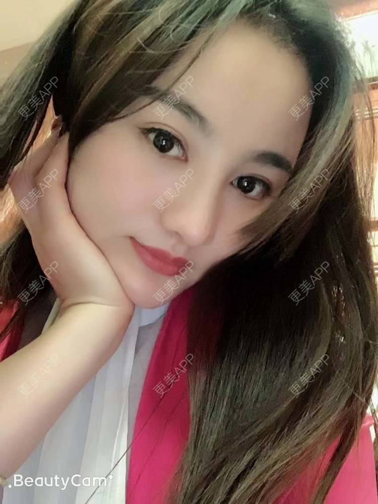 更美 - 更美用户tYzlahBO6T的植发际线经验 | 植发际线 | 深圳 | 毛发移植