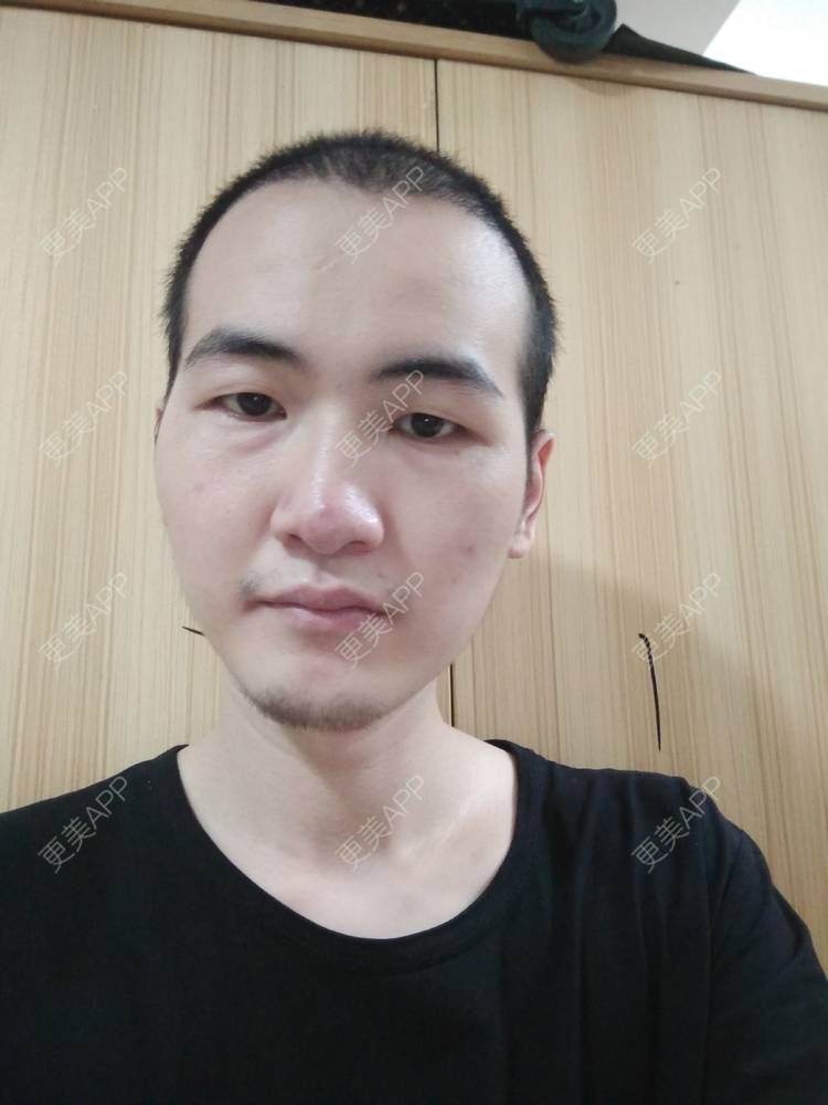 更美 - 更美用户wHSFRCieMm的植胡须经验 | 武汉 | 植胡须