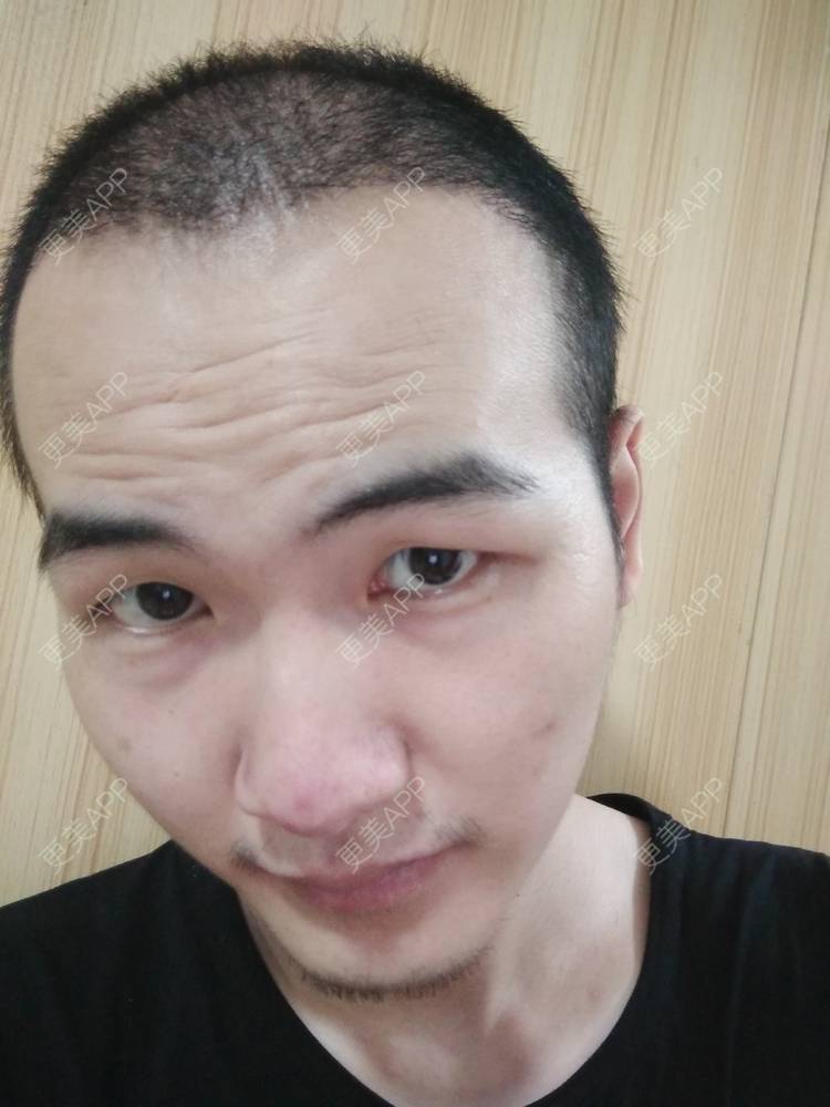 更美 - 更美用户wHSFRCieMm的植胡须经验 | 武汉 | 植胡须