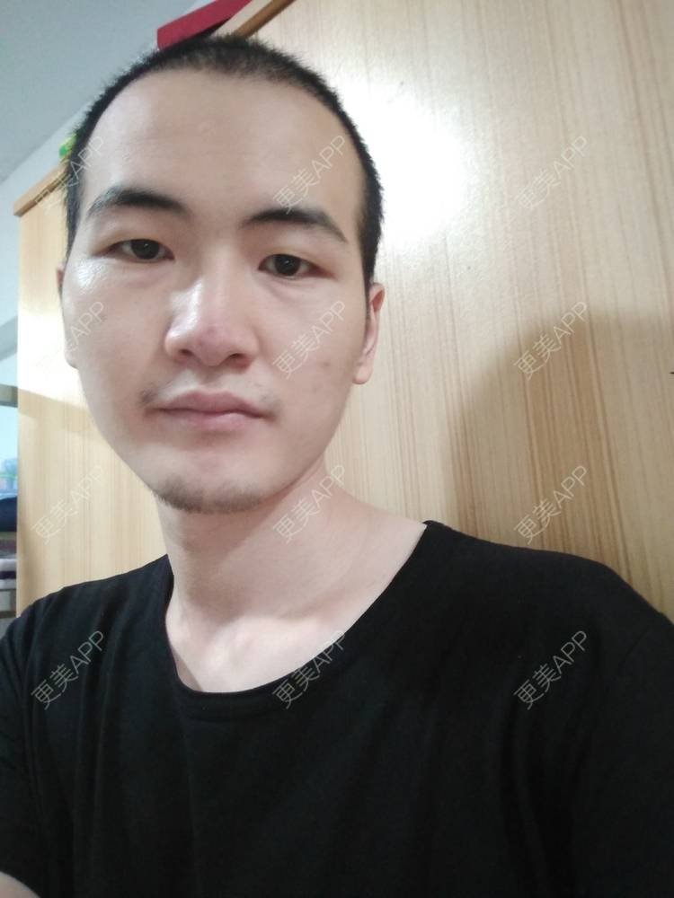 更美 - 更美用户wHSFRCieMm的植胡须经验 | 武汉 | 植胡须