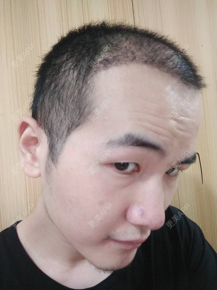 更美 - 更美用户wHSFRCieMm的植胡须经验 | 武汉 | 植胡须