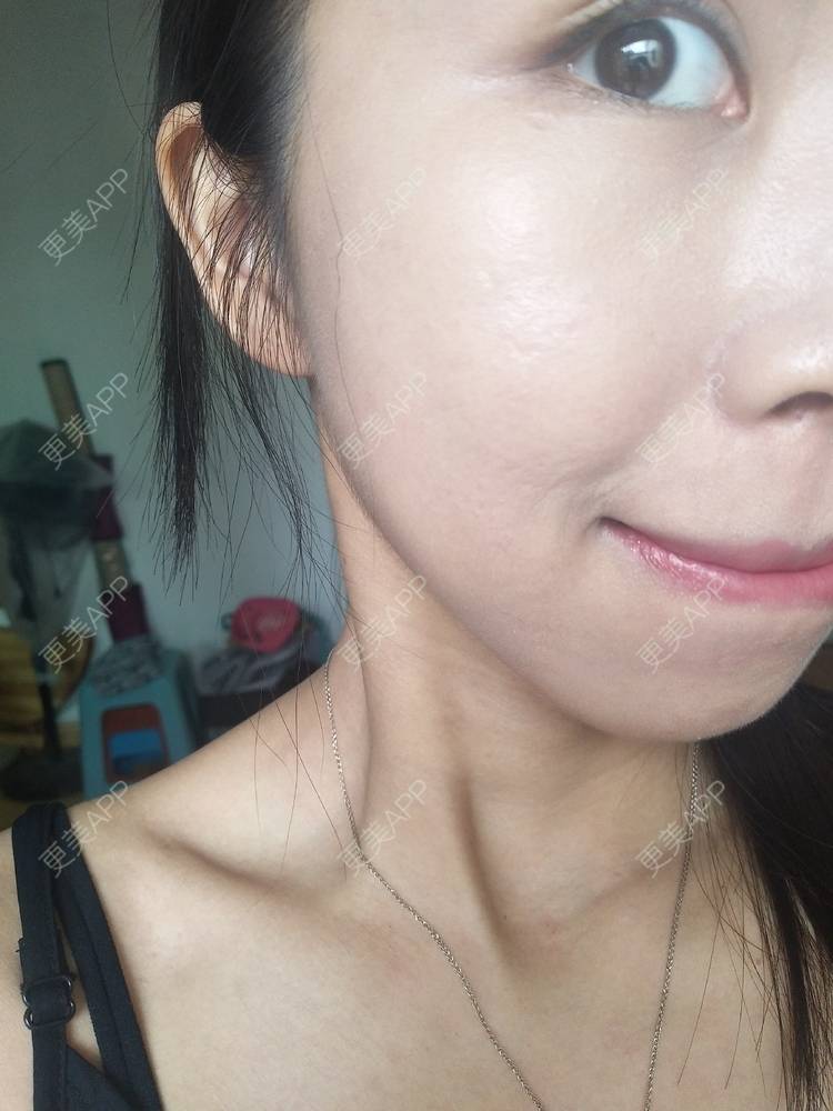 更美 - 更美用户YIHN9SmlH7的射频提升经验 | 深圳 | 射频提升