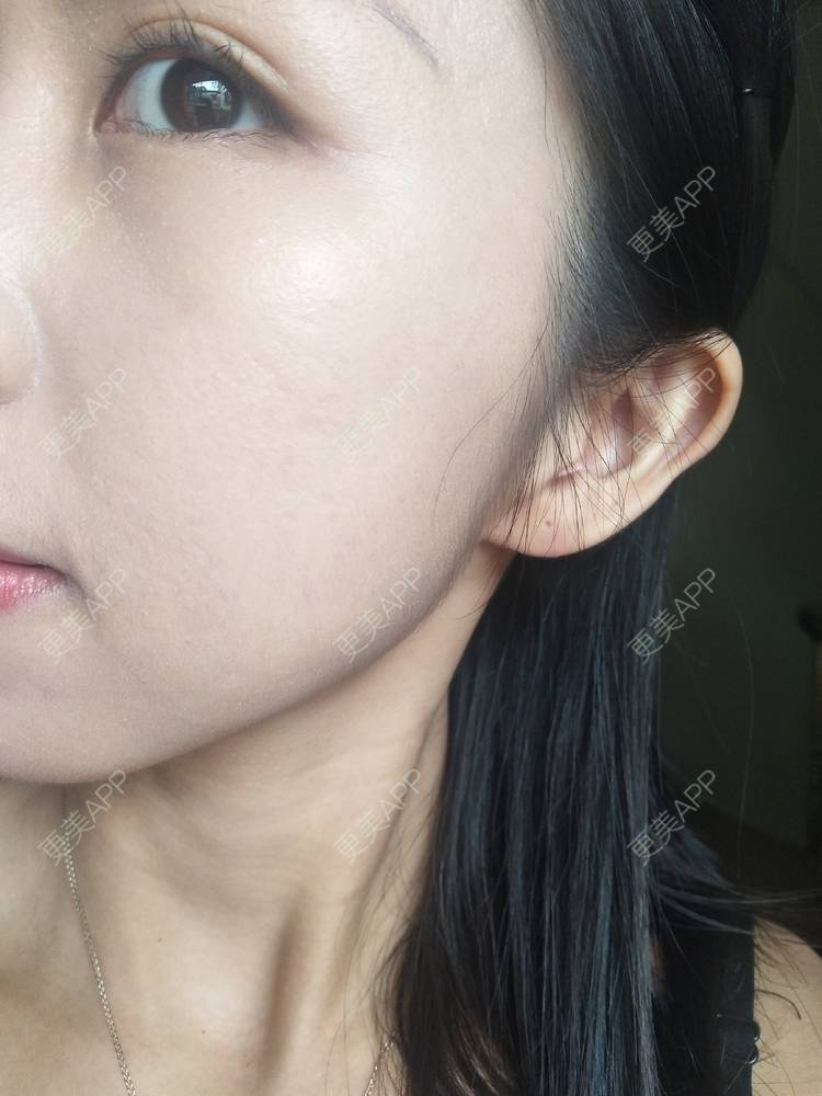 更美 - 更美用户YIHN9SmlH7的射频提升经验 | 深圳 | 射频提升