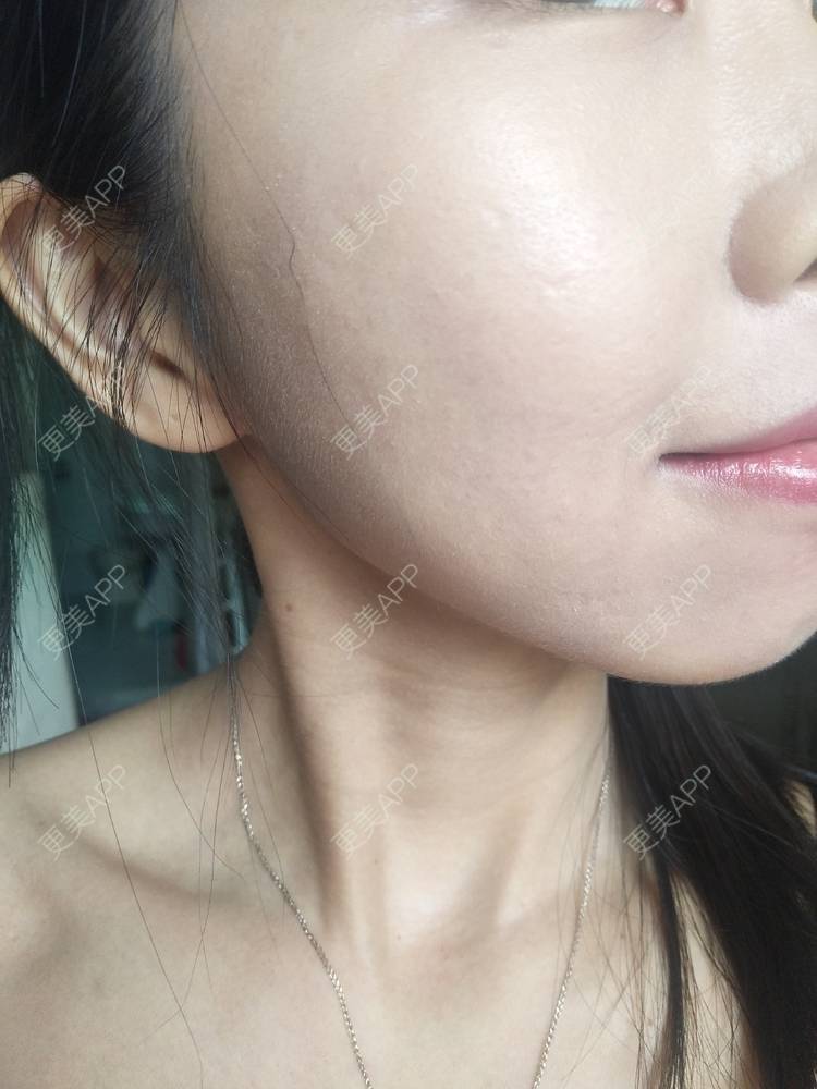 更美 - 更美用户YIHN9SmlH7的射频提升经验 | 深圳 | 射频提升