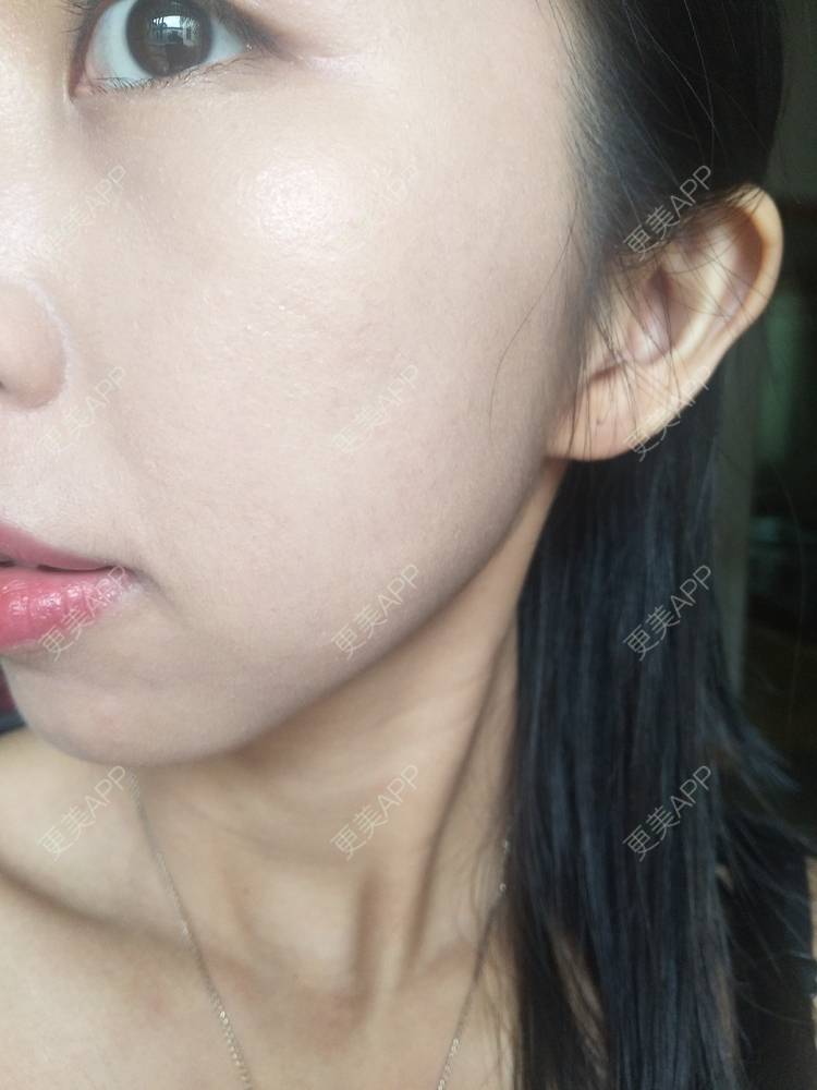 更美 - 更美用户YIHN9SmlH7的射频提升经验 | 深圳 | 射频提升