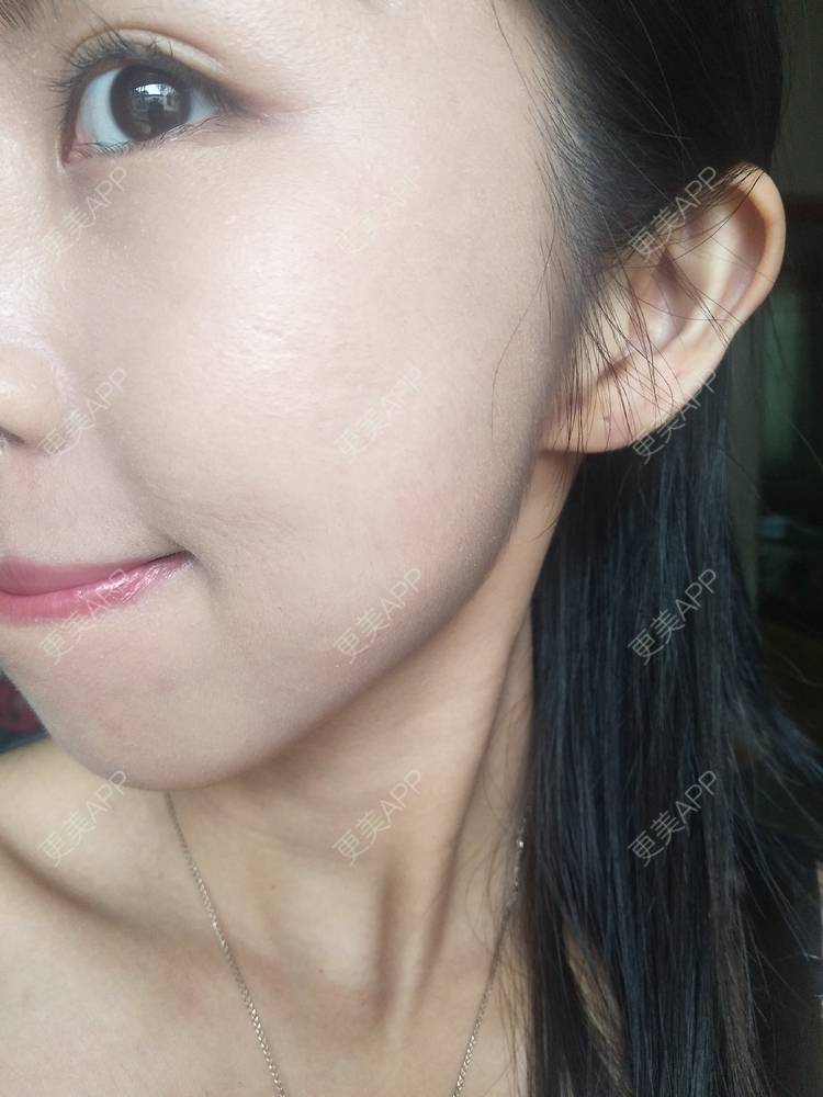 更美 - 更美用户YIHN9SmlH7的射频提升经验 | 深圳 | 射频提升