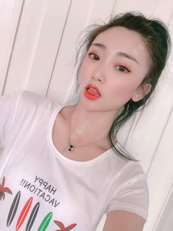 更美 - 大屁妞的厚唇改薄经验 | 厚唇改薄 | M唇成形 | 唇综合 | 北京
