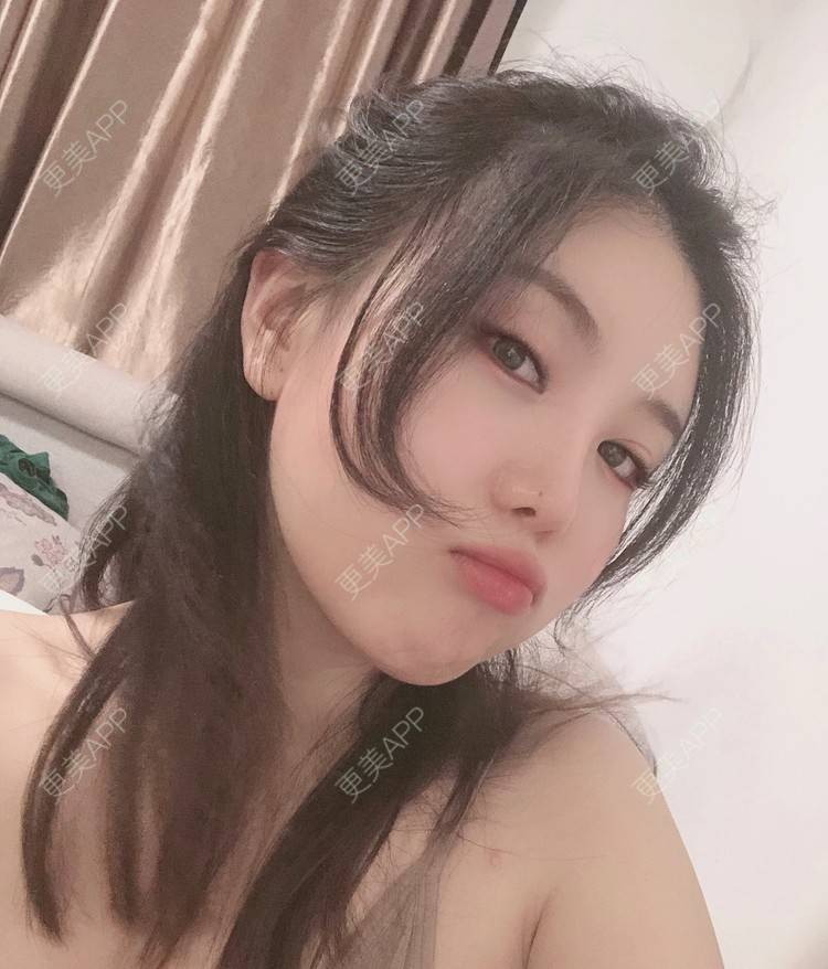 更美 - 兔子la的植发际线经验 | 广州 | 视频日记 | 植发际线