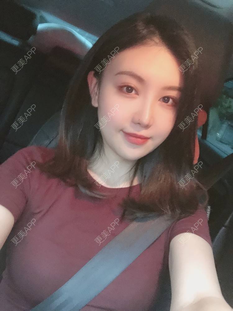 更美 - 兔子la的植发际线经验 | 广州 | 视频日记 | 植发际线