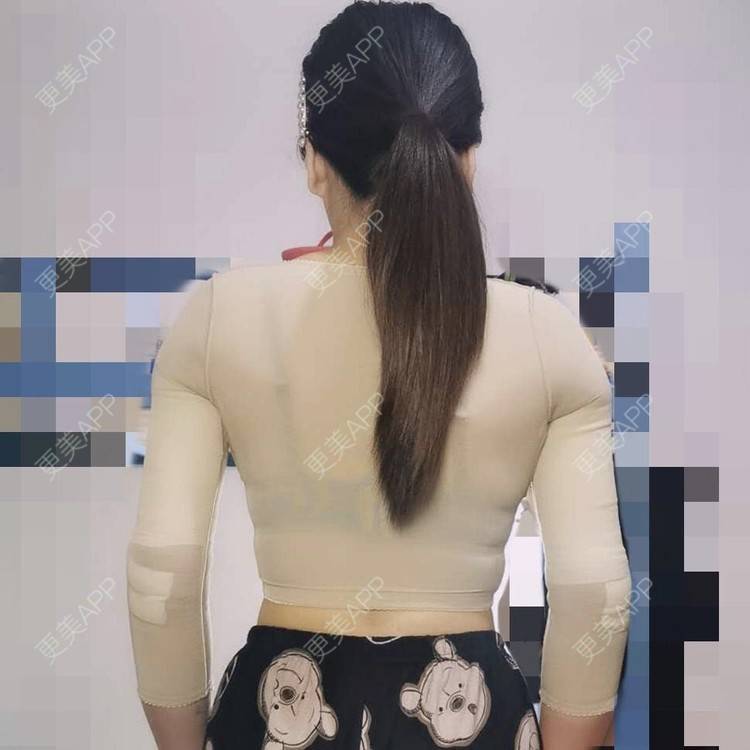 更美 - 更美用户KUkCDMQ6ZV的手臂吸脂经验 | 手臂吸脂 | 射频溶脂瘦手臂 | 青岛