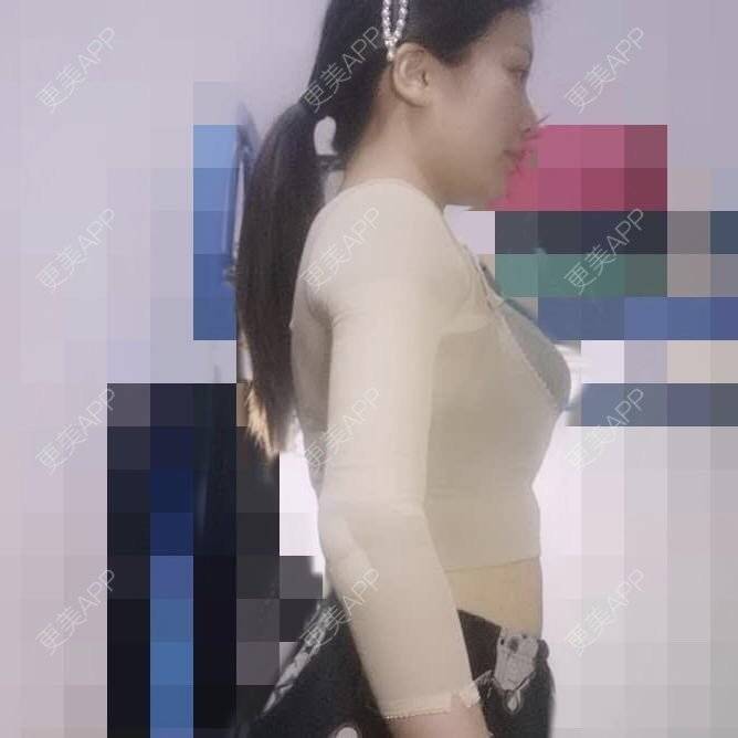 更美 - 更美用户KUkCDMQ6ZV的手臂吸脂经验 | 手臂吸脂 | 射频溶脂瘦手臂 | 青岛