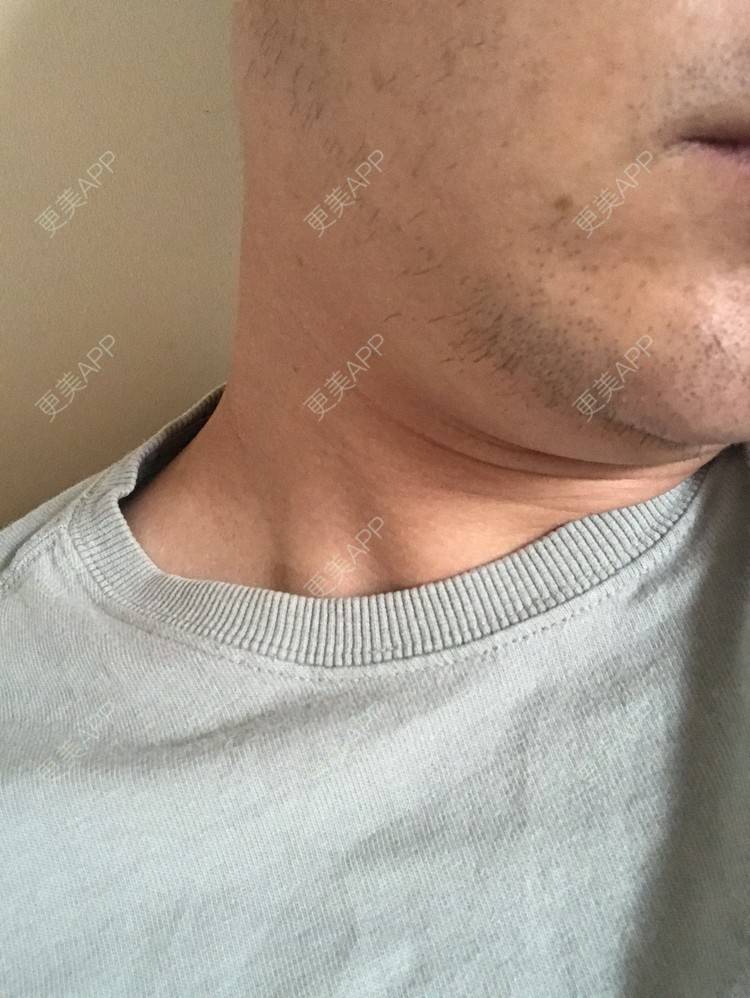 更美 - 倔强的老草的除皱瘦脸经验 | 除皱瘦脸 | 上海