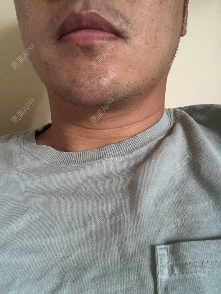 更美 - 倔强的老草的除皱瘦脸经验 | 除皱瘦脸 | 上海