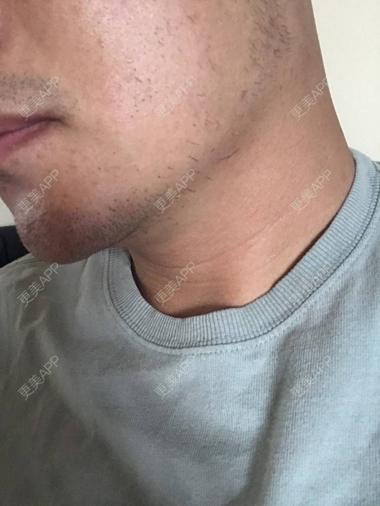 更美 - 倔强的老草的除皱瘦脸经验 | 除皱瘦脸 | 上海