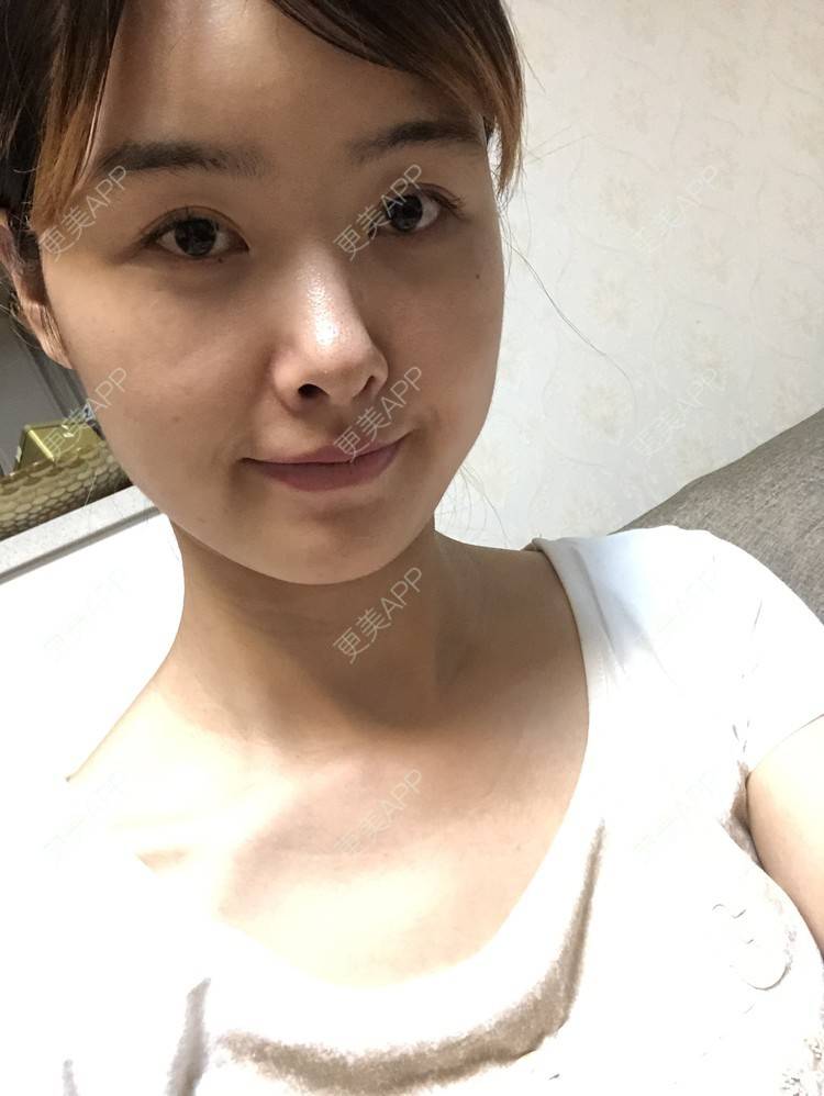 更美 - 更美用户VreGcNHyrd的隆鼻经验 | 隆鼻 | 膨体隆鼻 | 十堰 | 耳软骨隆鼻